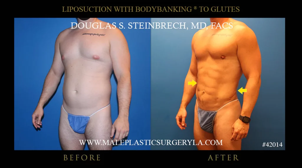 Liposuction - Before & After Photos