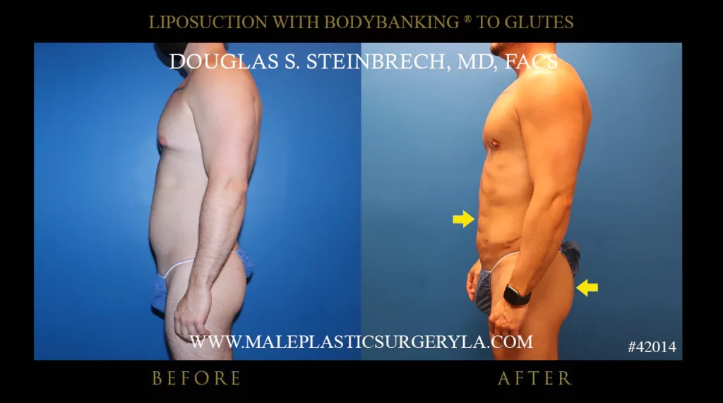 Liposuction - Before & After Photos