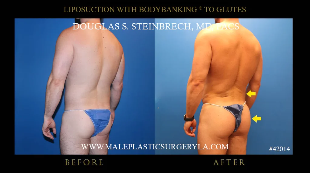 Liposuction - Before & After Photos