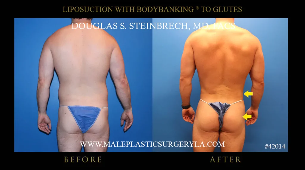 Liposuction - Before & After Photos