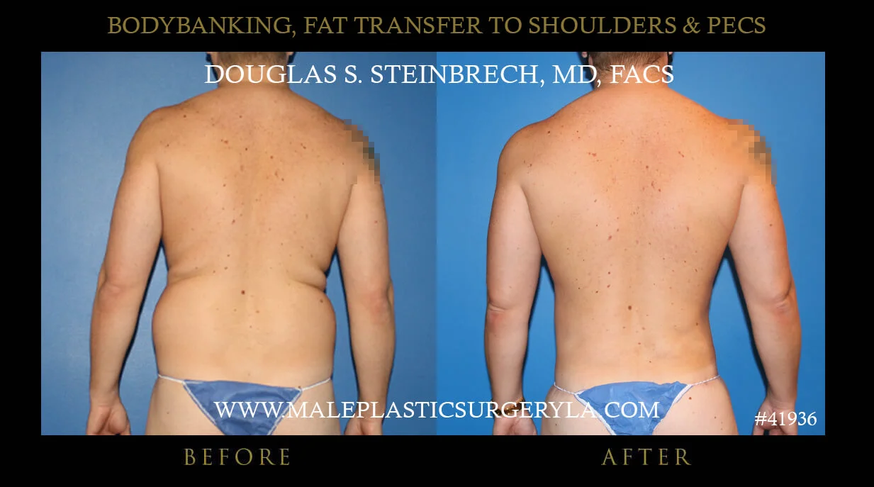 Liposuction - Before & After Photos