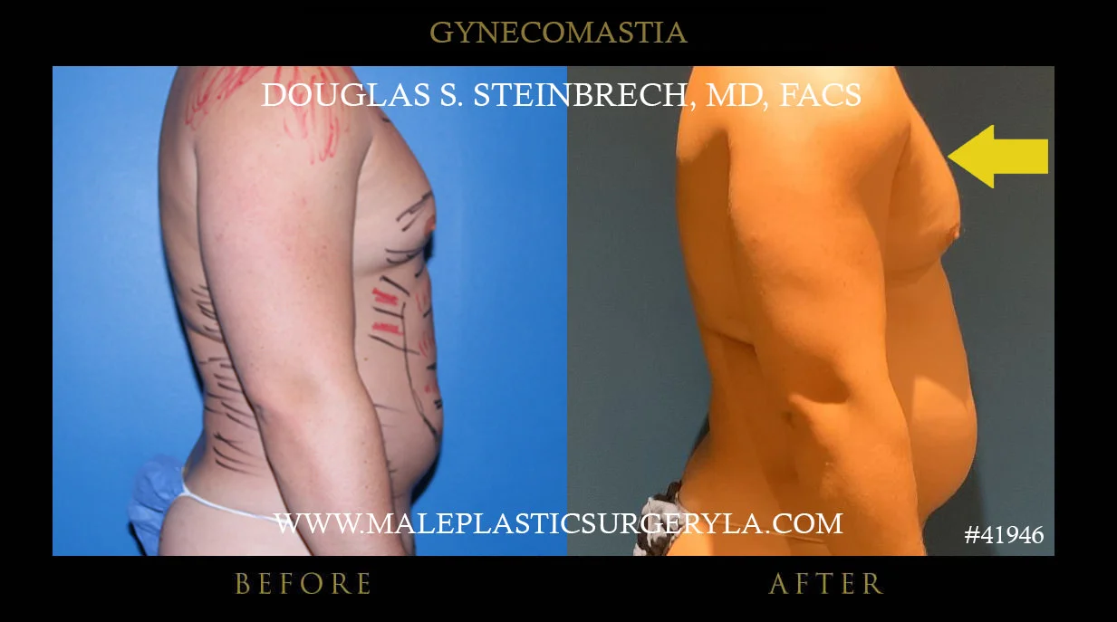 Gynecomastia - Before & After Photos