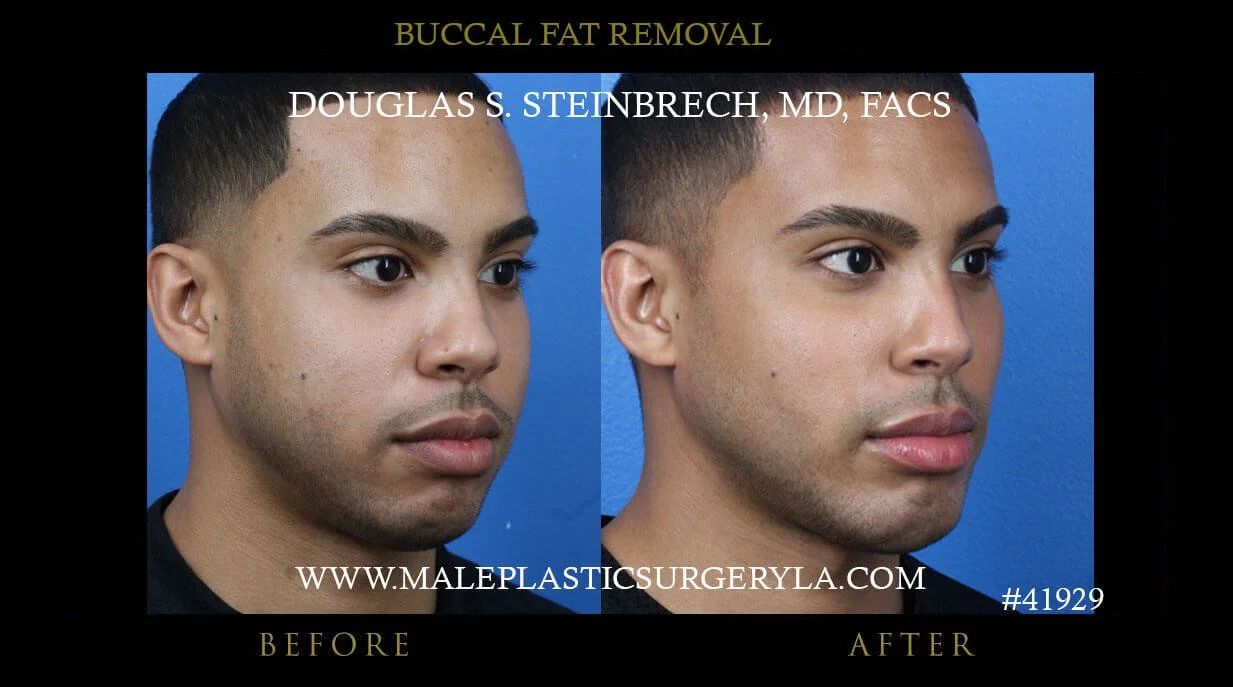 Buccal Fat Removal - Before & After Photos