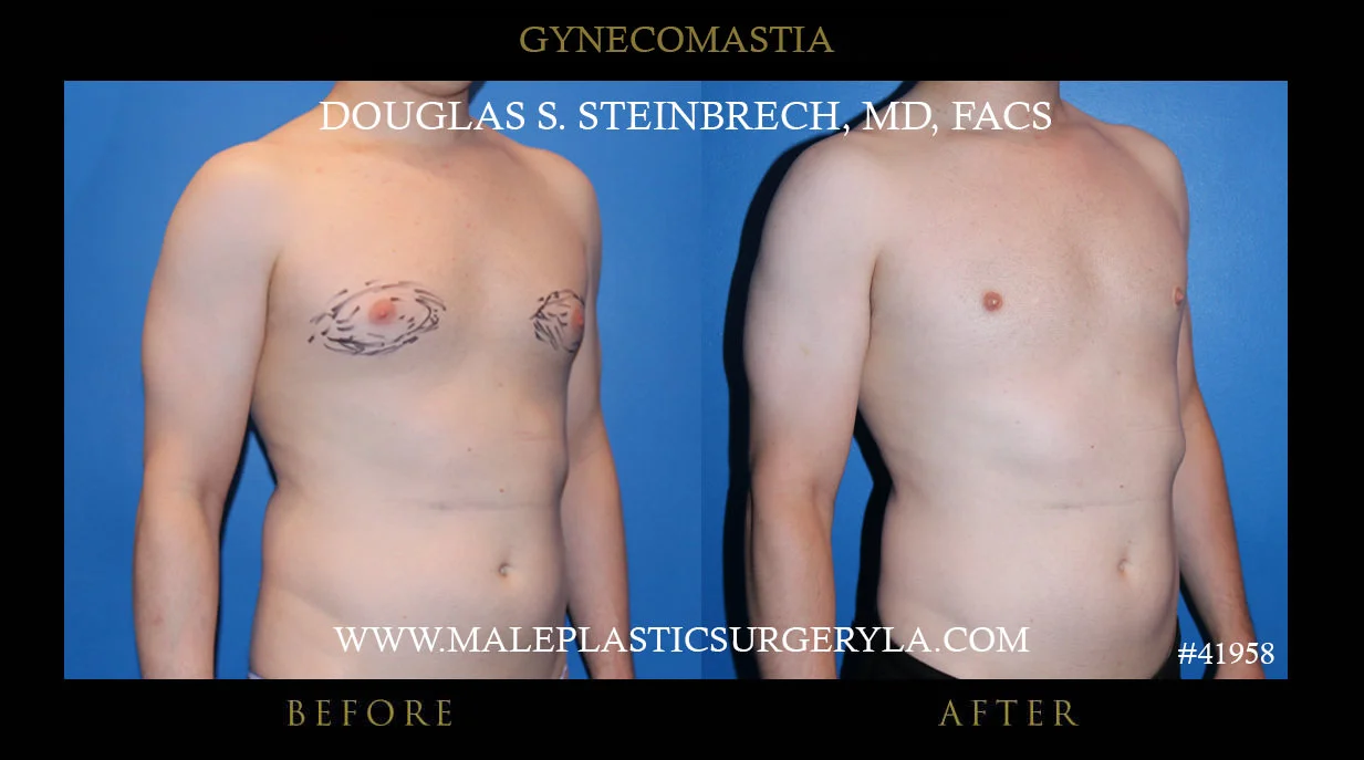 Gynecomastia - Before & After Photos