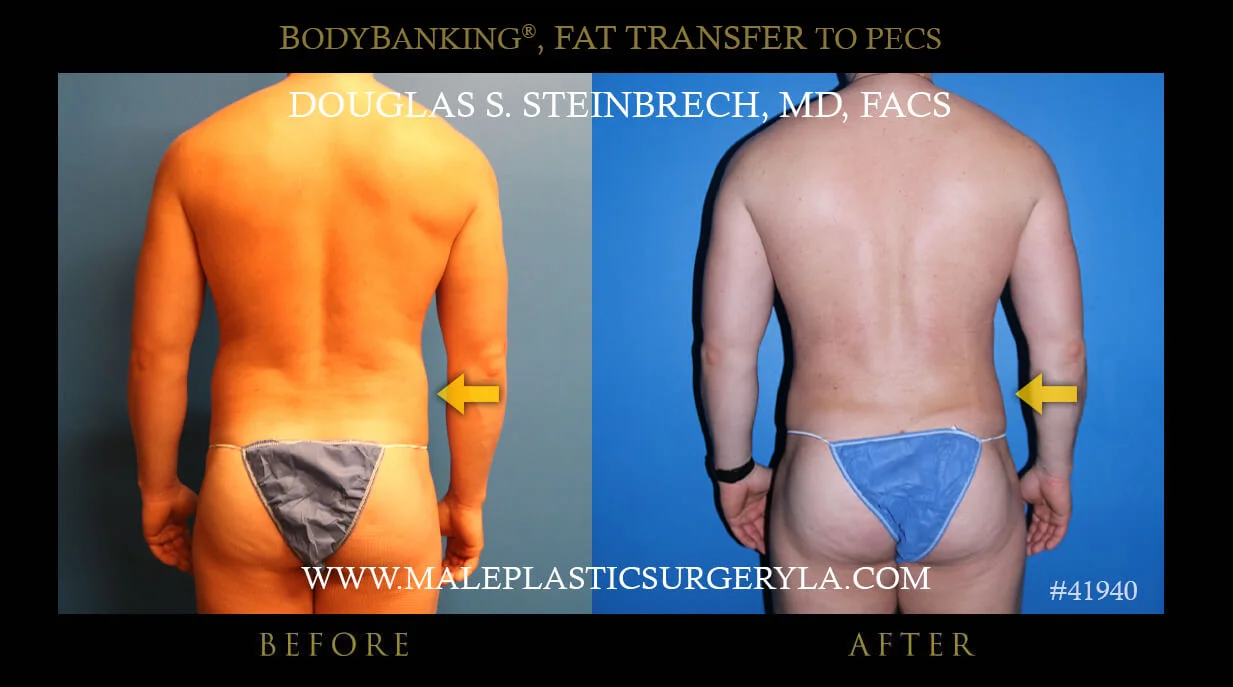 Liposuction - Before & After Photos