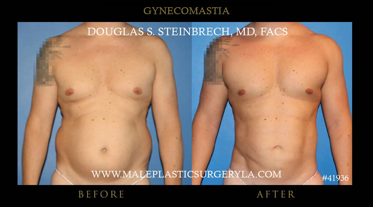 Gynecomastia - Before & After Photos