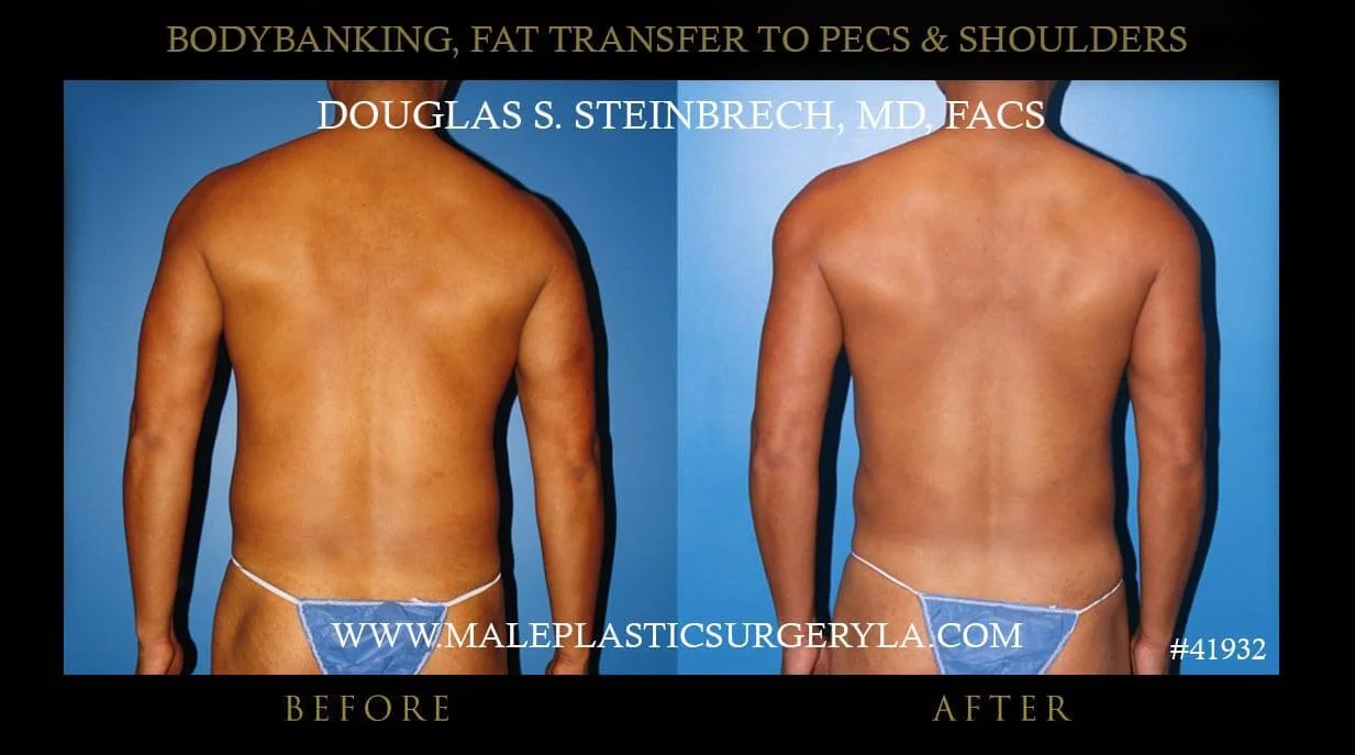 Liposuction - Before & After Photos