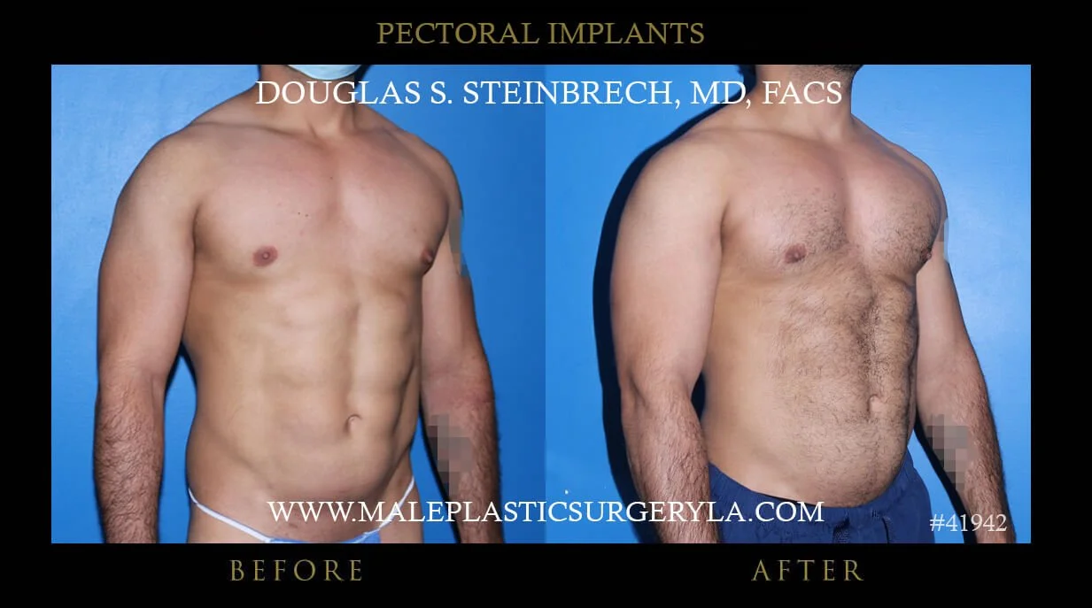 Pectoral Chest Implant - Before & After Photos