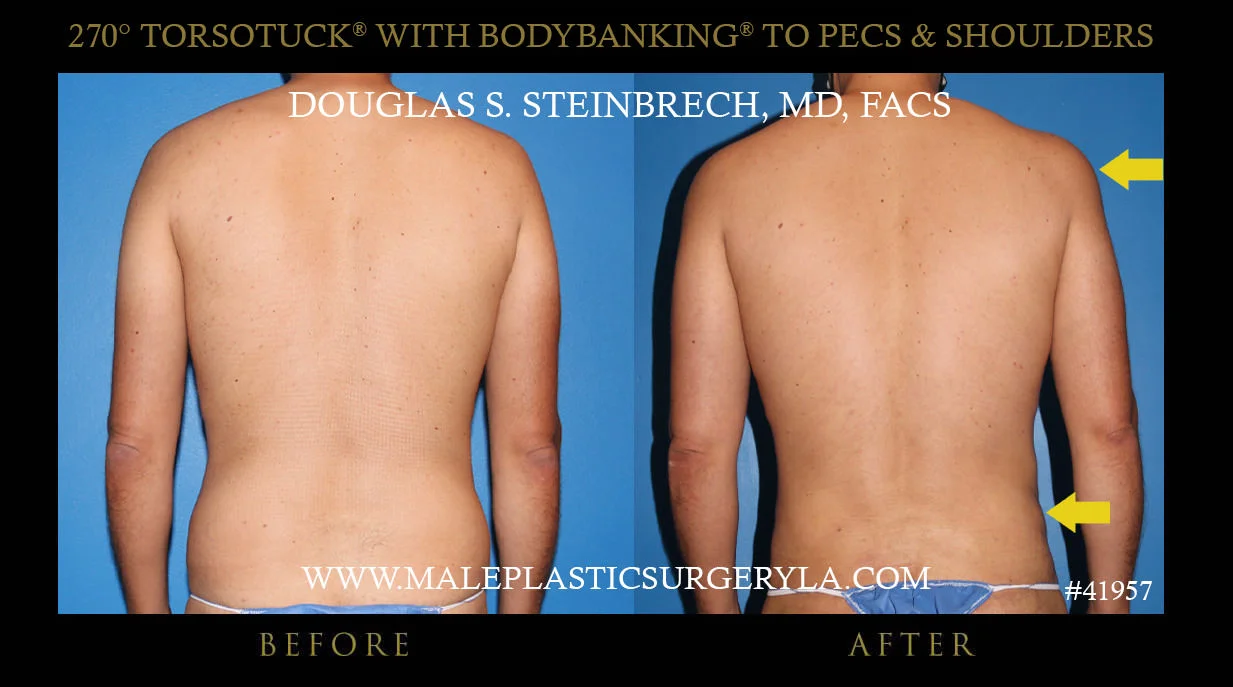 Gynecomastia - Before & After Photos