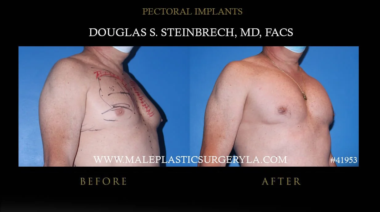 Pectoral Chest Implant - Before & After Photos