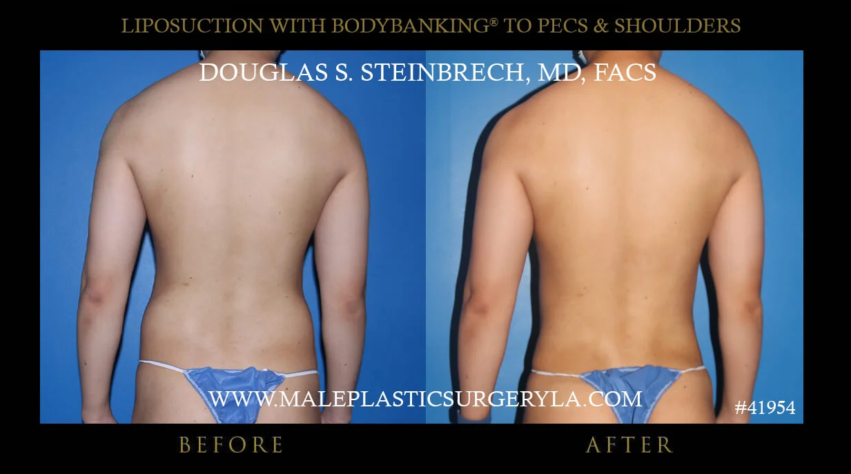 Liposuction - Before & After Photos