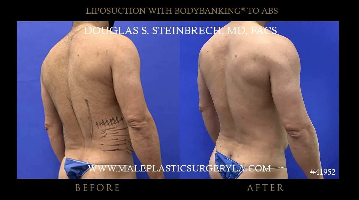 Liposuction - Before & After Photos