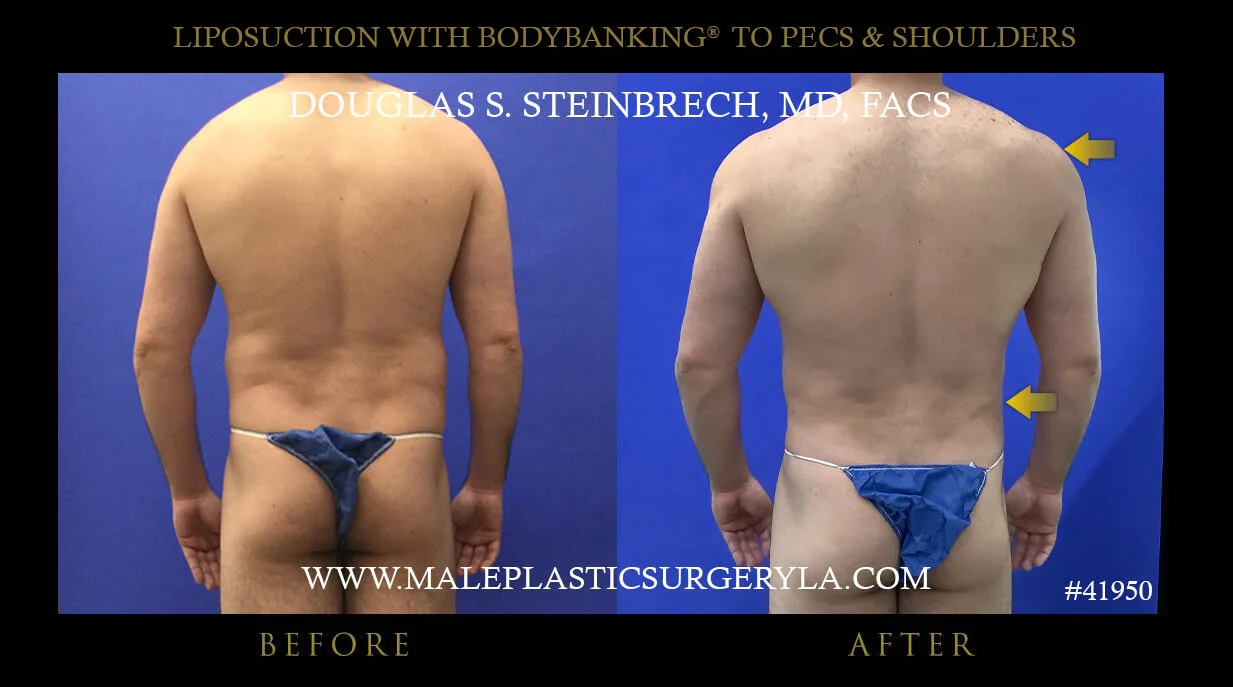 Liposuction - Before & After Photos