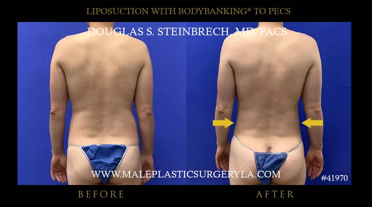 Liposuction - Before & After Photos