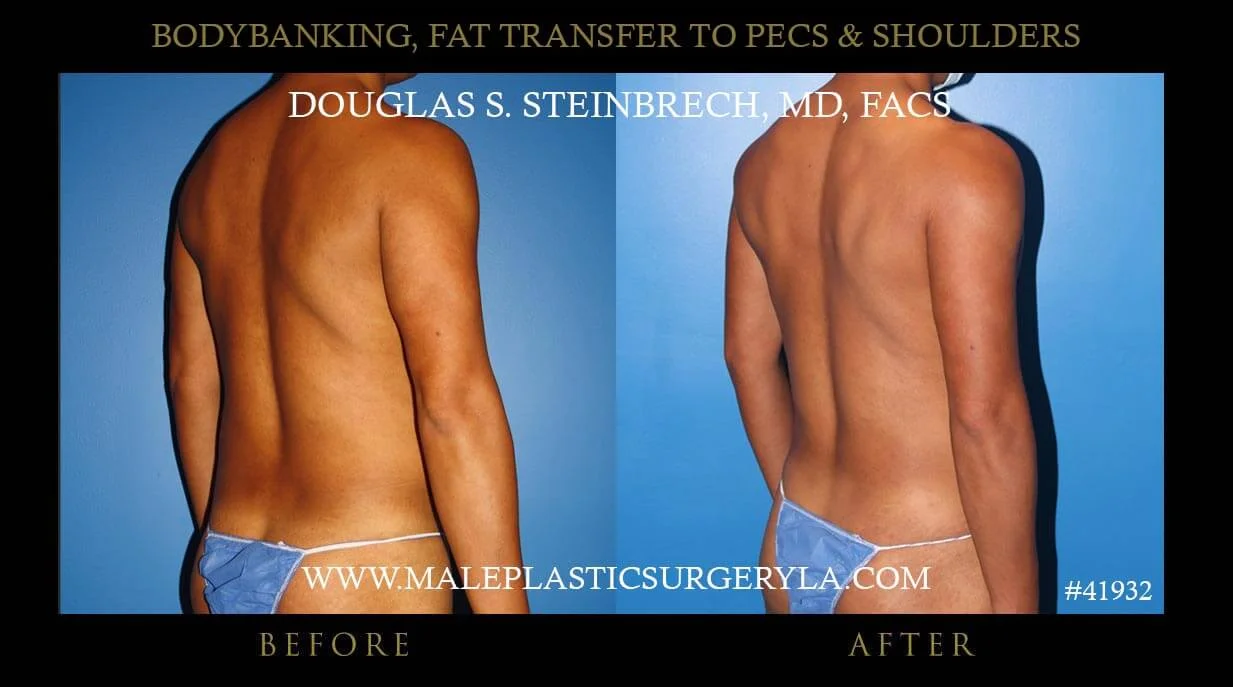 Liposuction - Before & After Photos