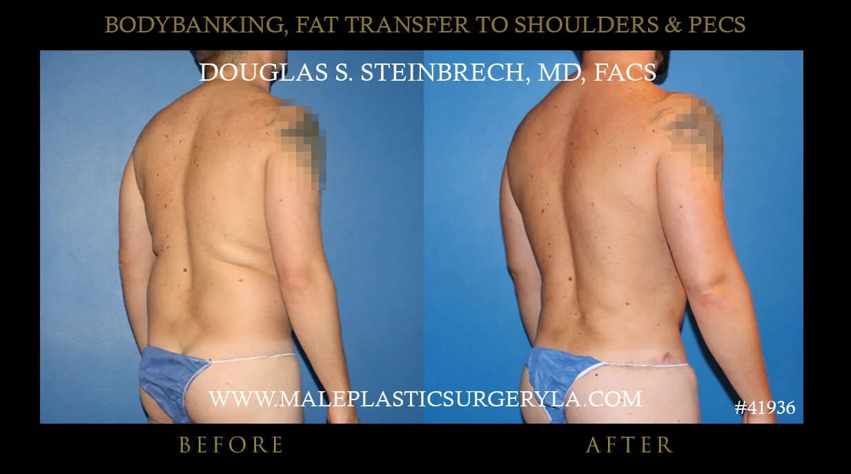 Liposuction - Before & After Photos