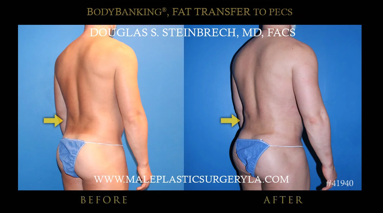 Liposuction - Before & After Photos