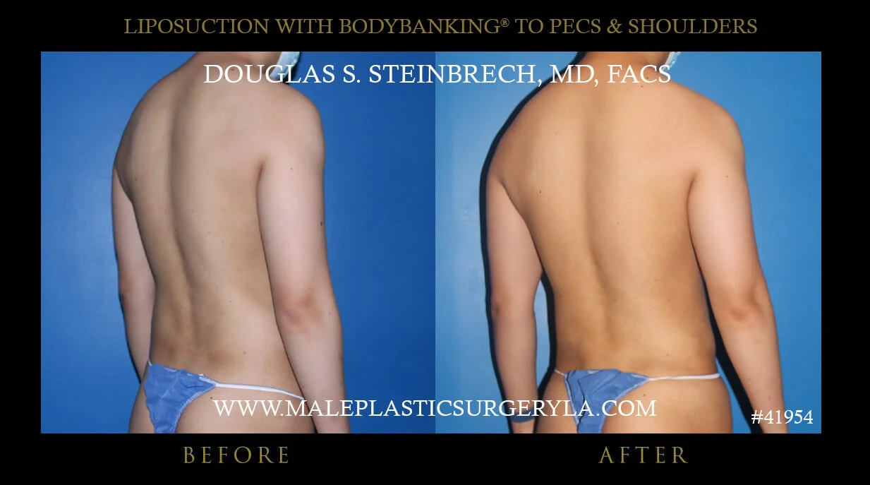 Liposuction - Before & After Photos