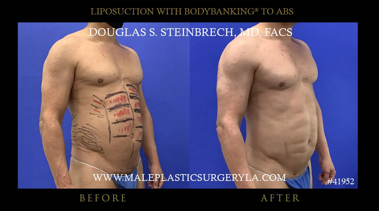 Liposuction - Before & After Photos