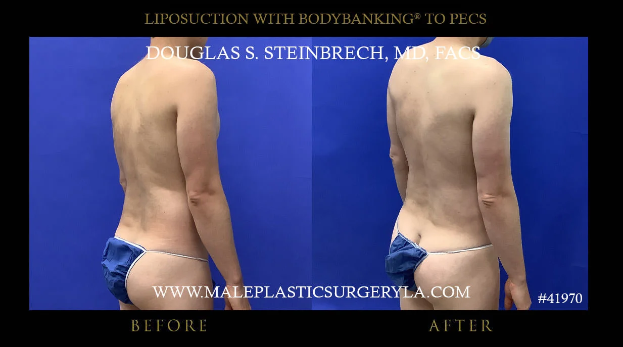 Liposuction - Before & After Photos