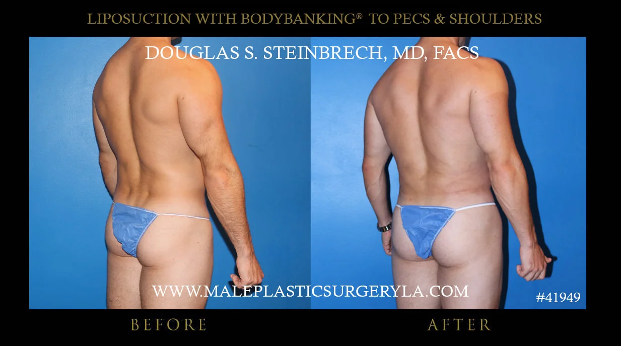 Liposuction - Before & After Photos