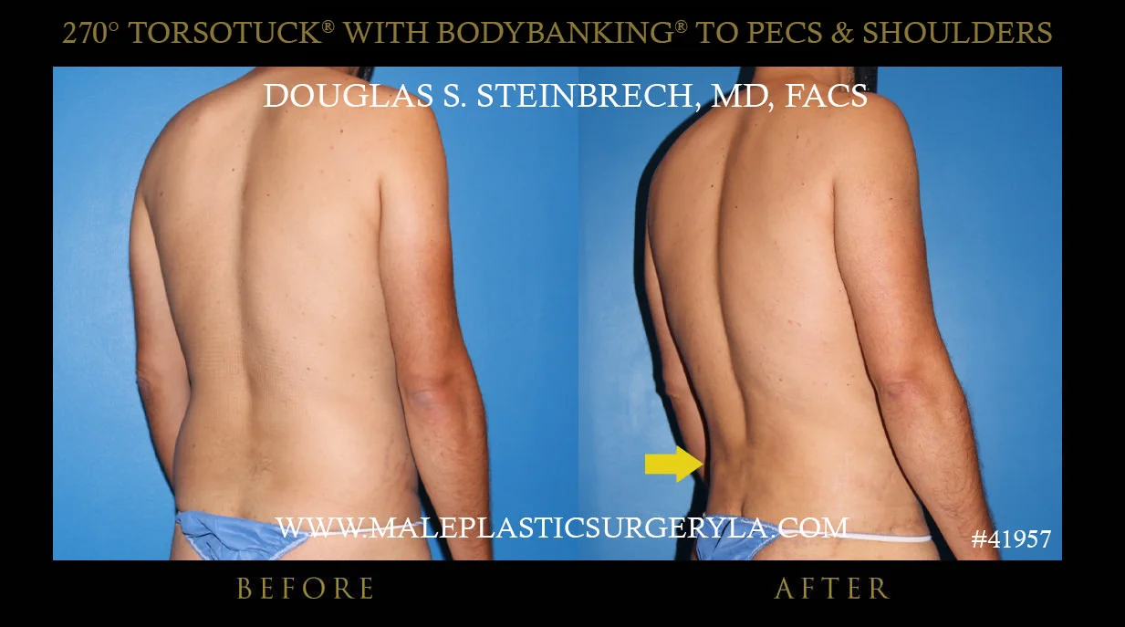 Gynecomastia - Before & After Photos