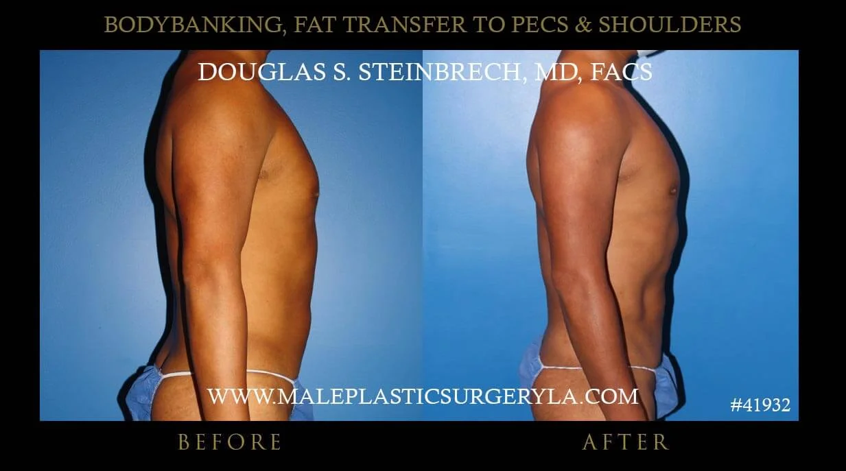 Liposuction - Before & After Photos