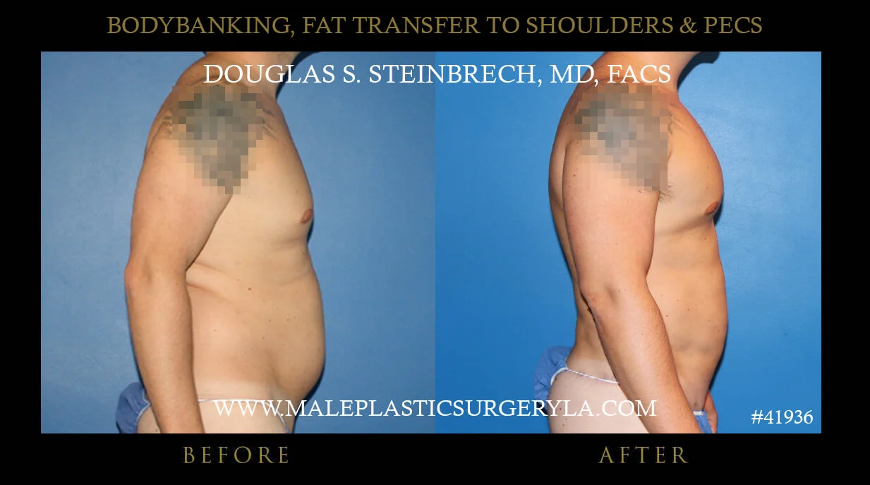 Liposuction - Before & After Photos