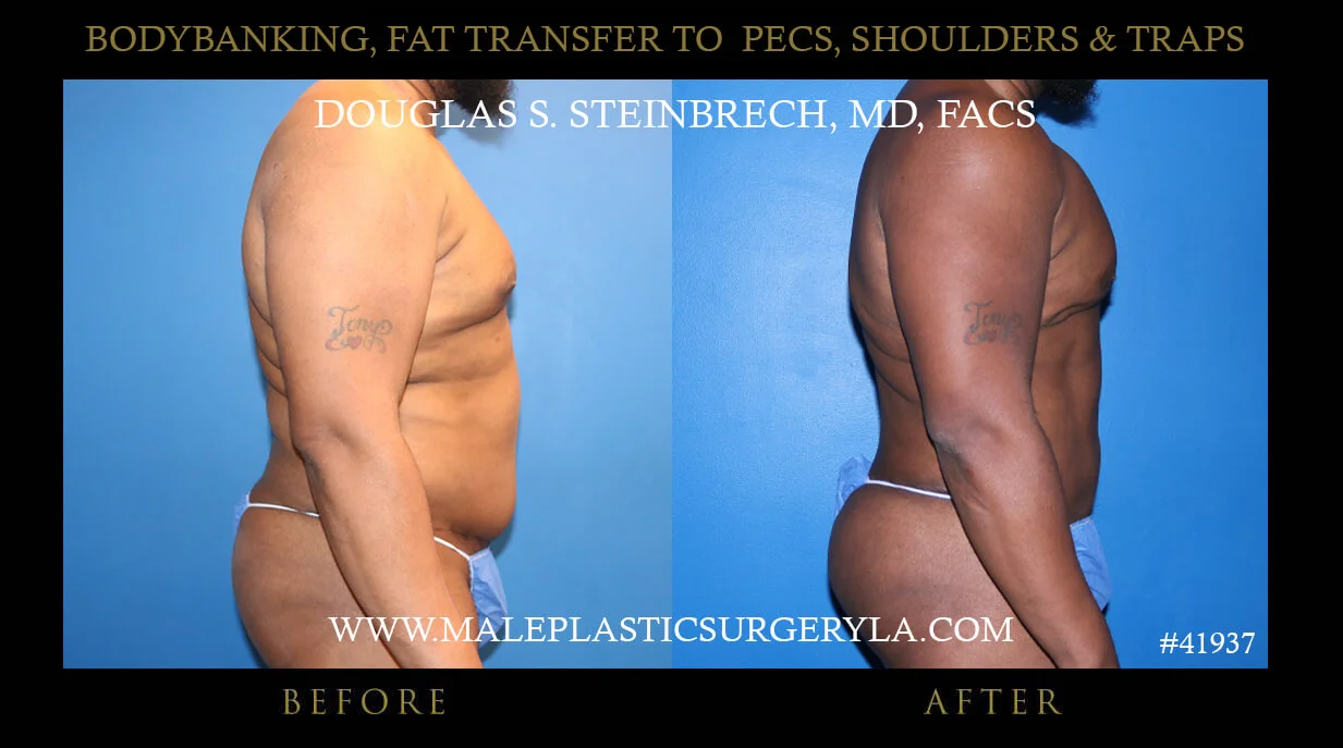 Liposuction - Before & After Photos