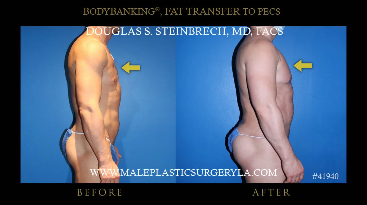 Liposuction - Before & After Photos