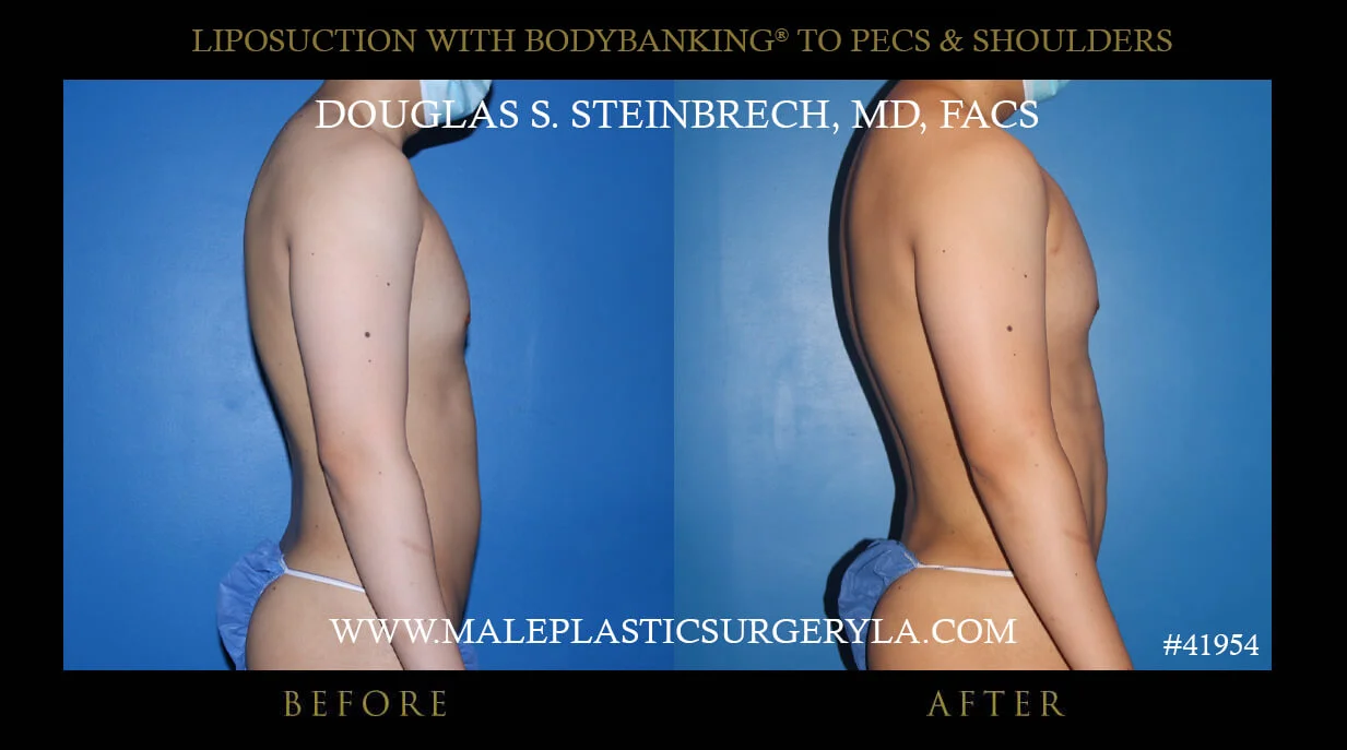 Liposuction - Before & After Photos