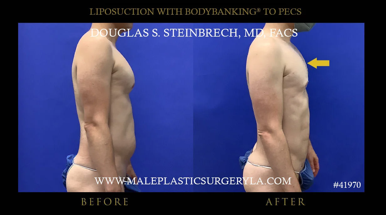 Liposuction - Before & After Photos