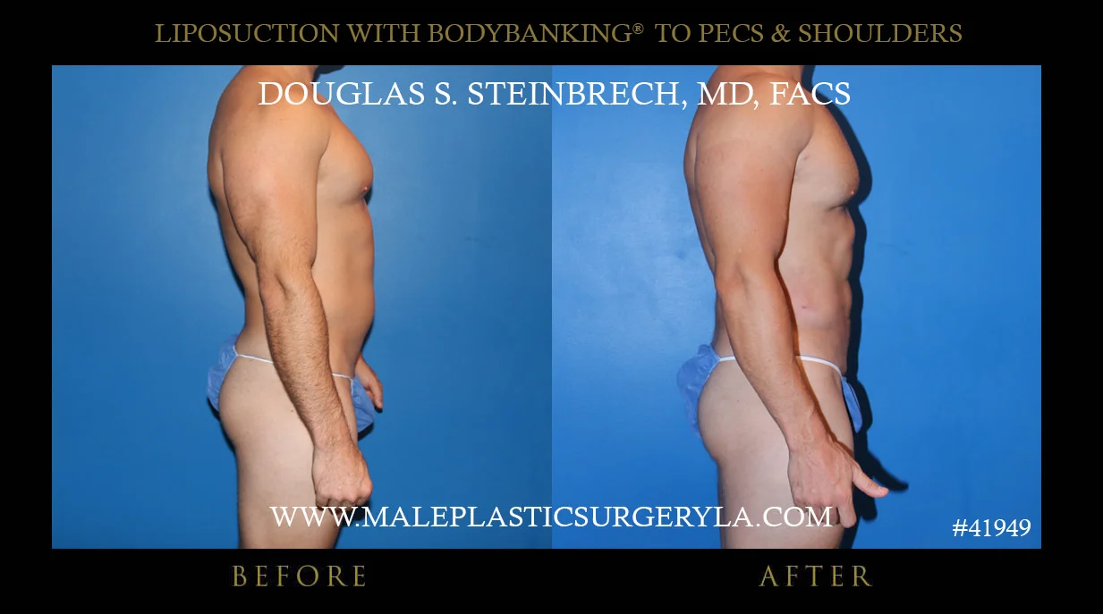 Liposuction - Before & After Photos