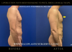 7-lipo-bodybanking-to-pecs-shoulders-traps-right-side-la