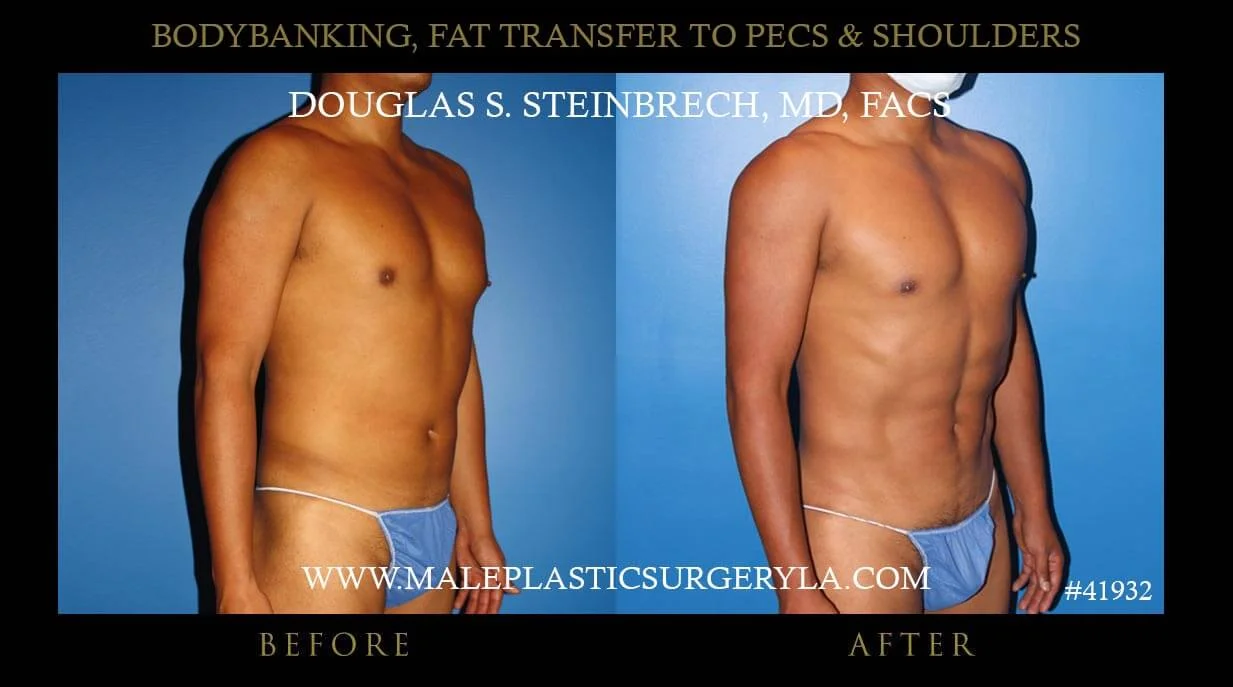 Liposuction - Before & After Photos