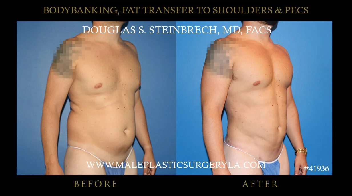 Liposuction - Before & After Photos