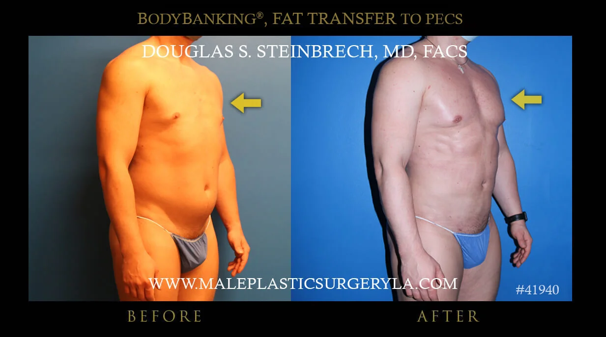 Liposuction - Before & After Photos