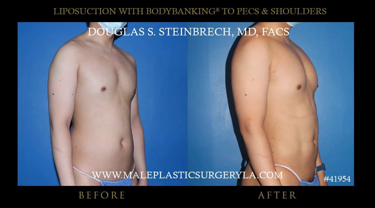 Liposuction - Before & After Photos