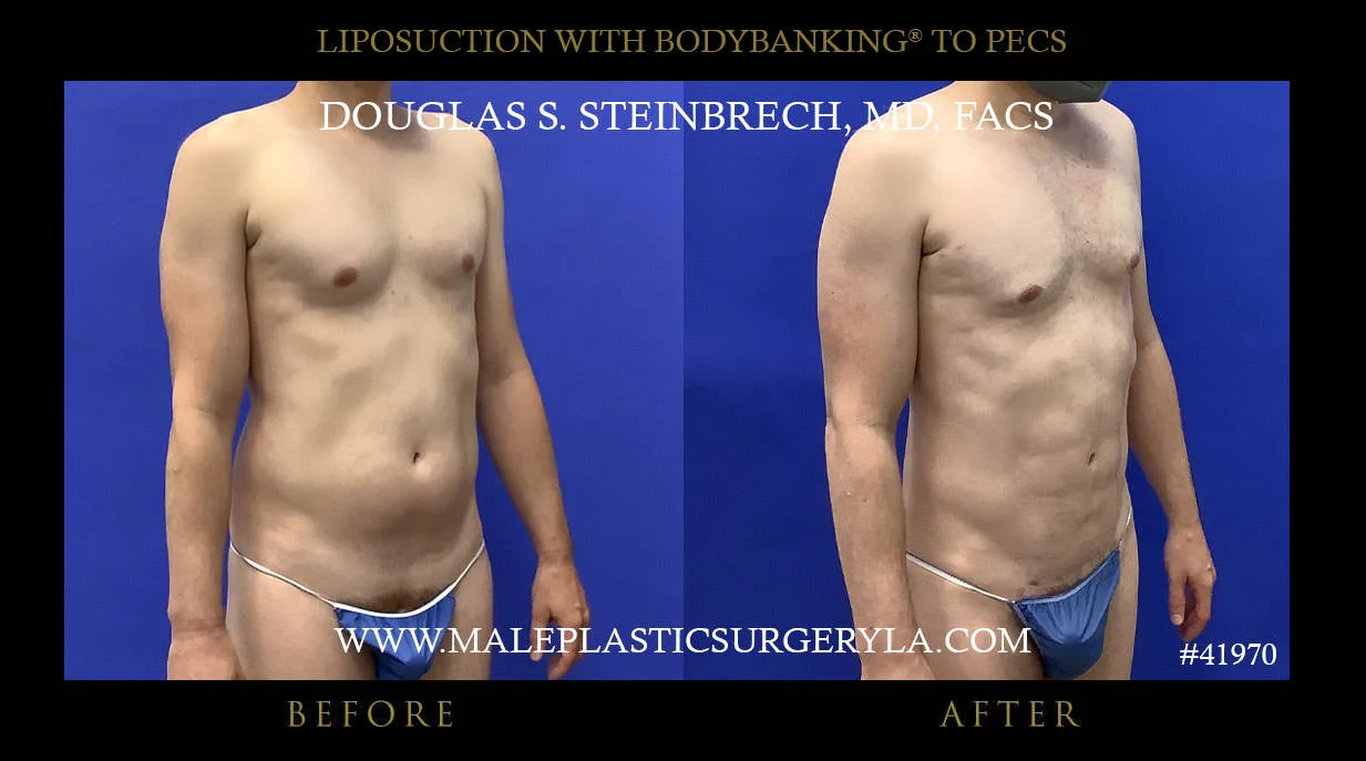 Liposuction - Before & After Photos