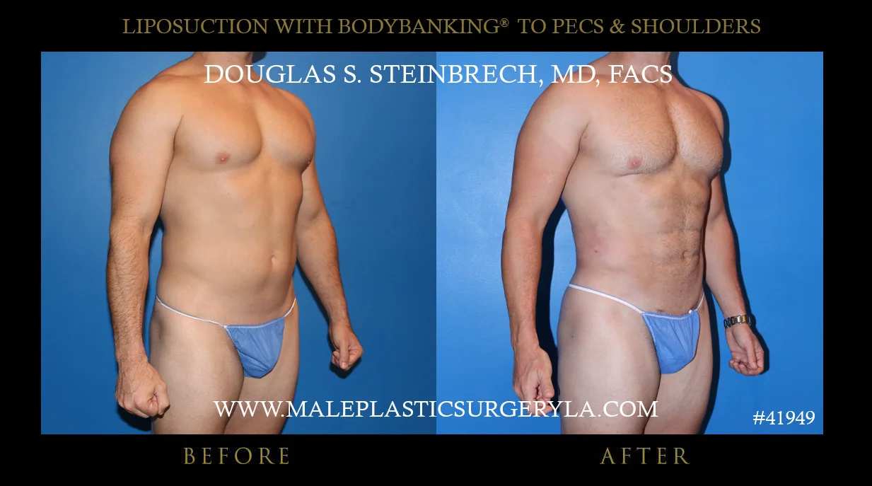 Liposuction - Before & After Photos