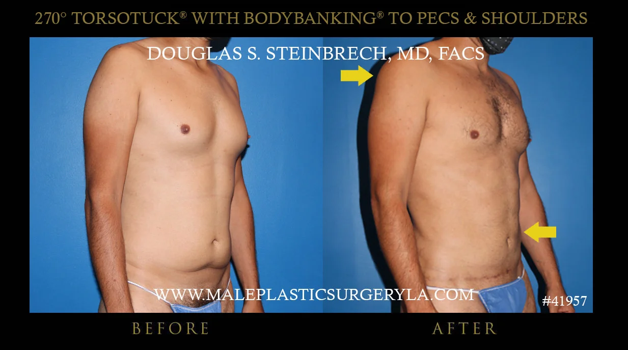 Gynecomastia - Before & After Photos