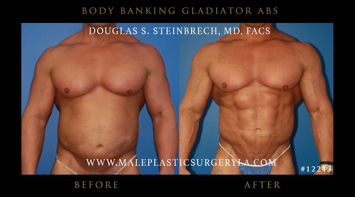 Gladiator Abs - Before & After Photos