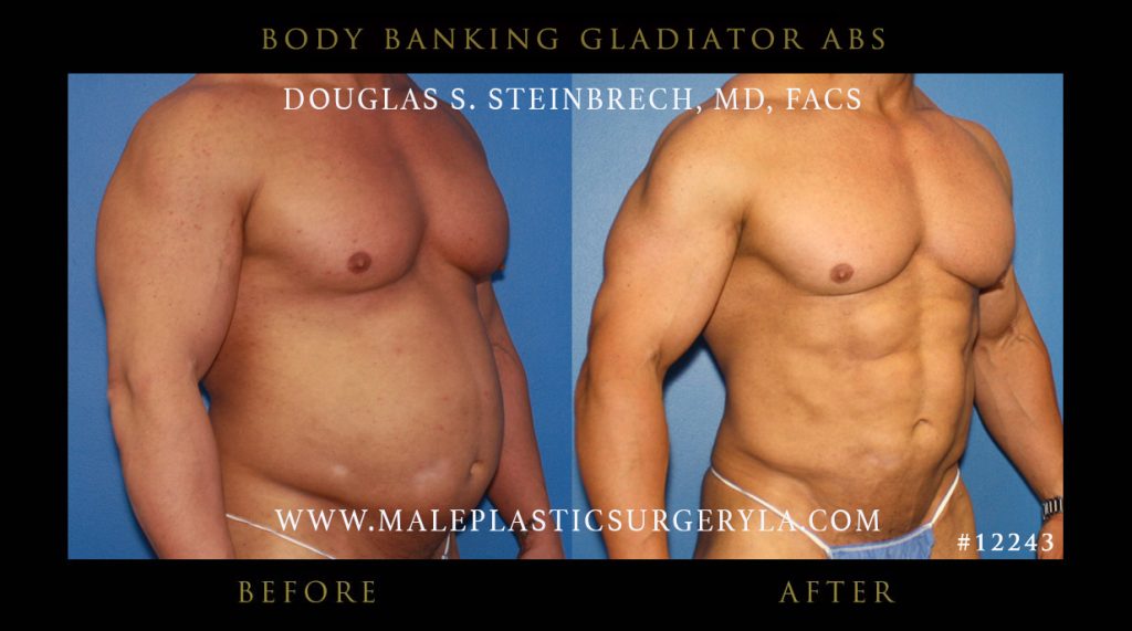 Gladiator Abs - Before & After Photos