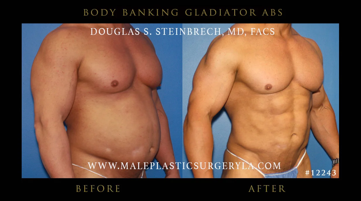 Gladiator Abs - Before & After Photos