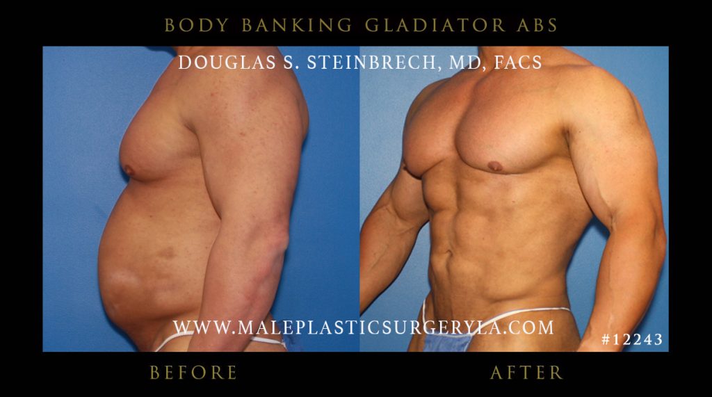 Gladiator Abs - Before & After Photos