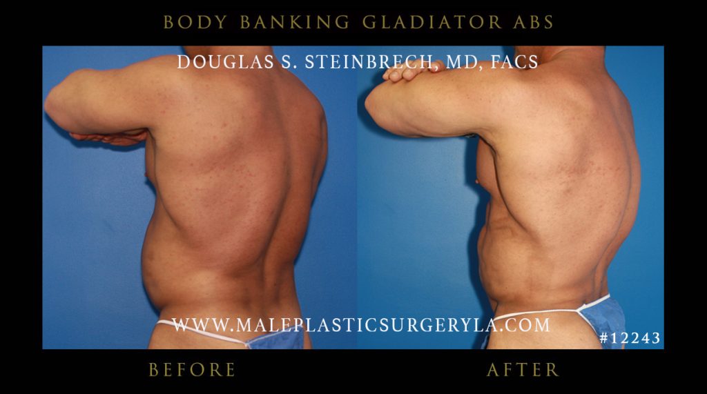 Gladiator Abs - Before & After Photos