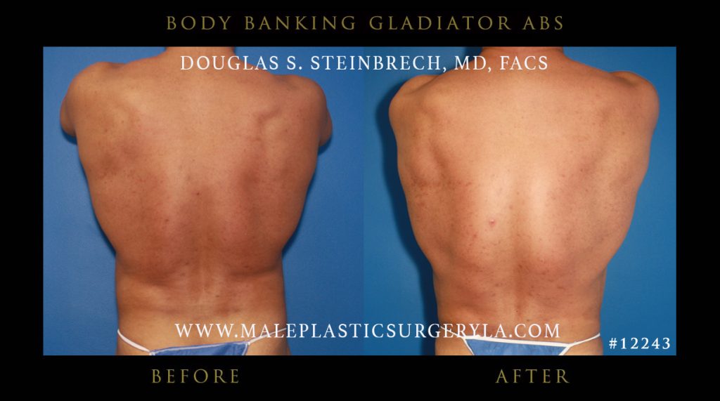 Gladiator Abs - Before & After Photos