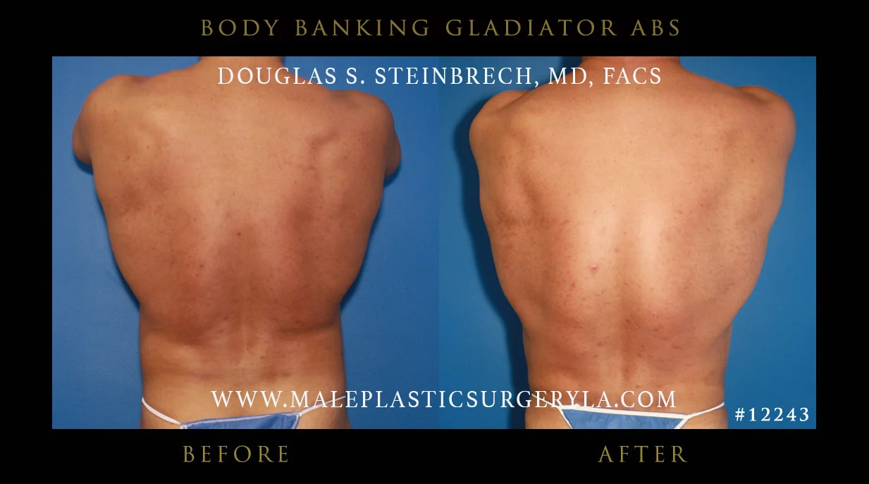 Liposuction - Before & After Photos