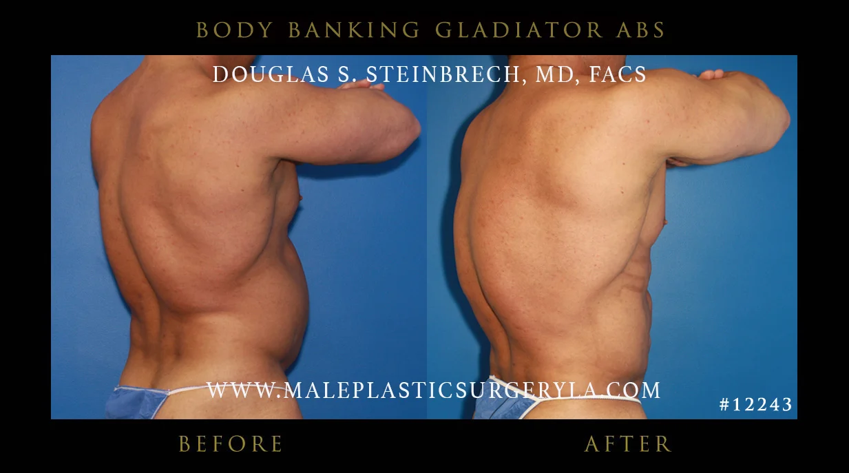 Gladiator Abs - Before & After Photos