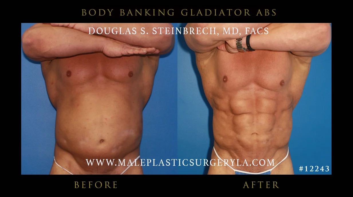 Gladiator Abs - Before & After Photos